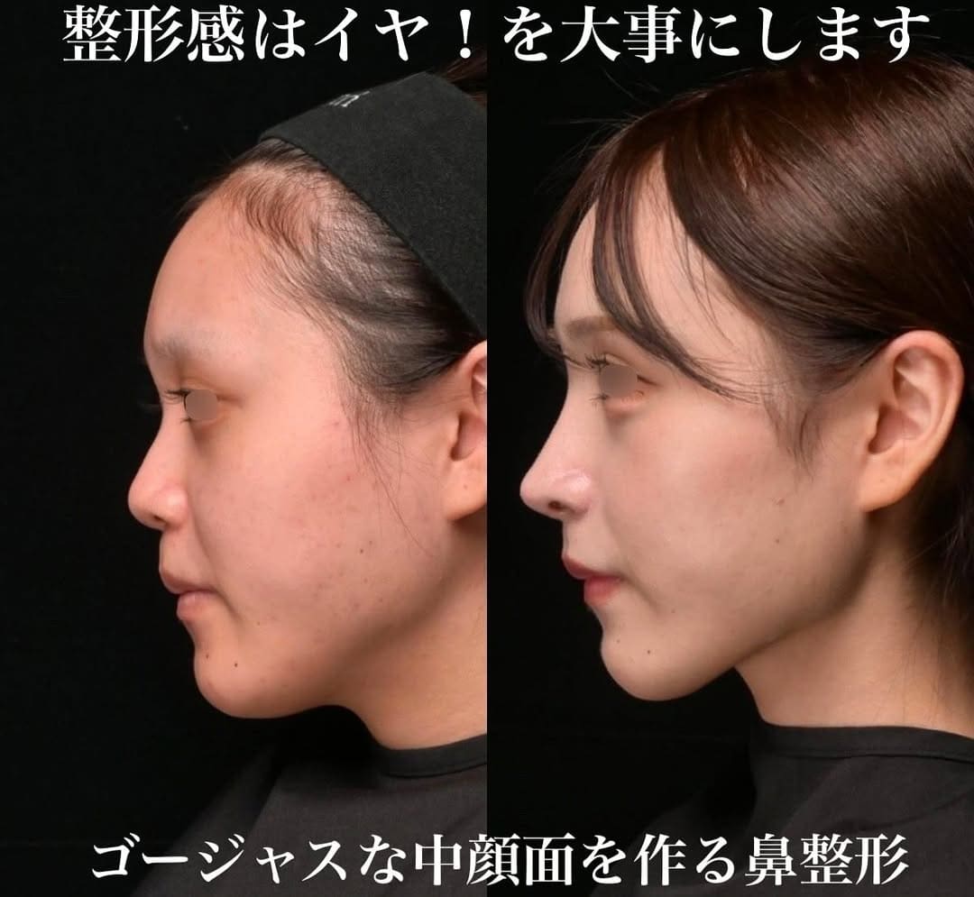 鉄医師による鼻整形の術前/術後３ヶ月 หลัง 