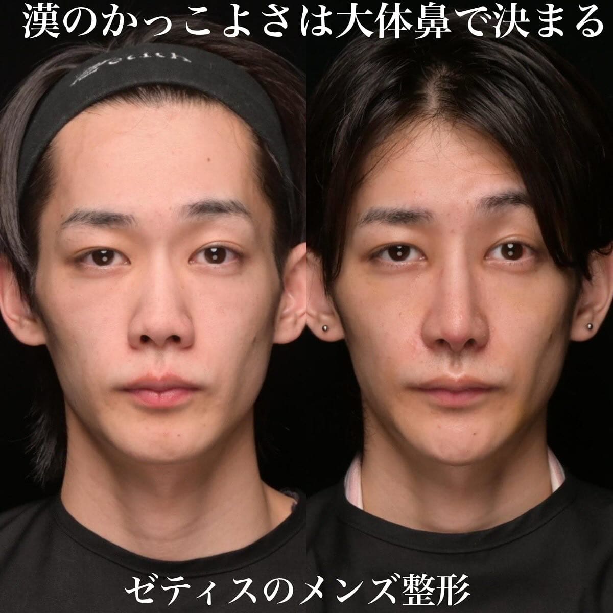 鉄医師による鼻整形の術前/術後2週間