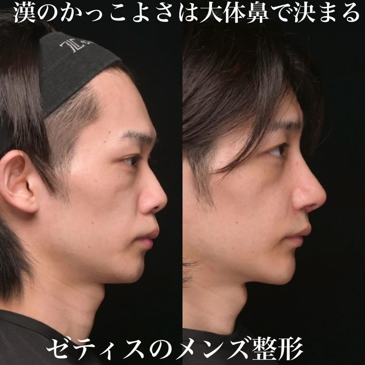 鉄医師による鼻整形の術前/術後2週間 施術後 