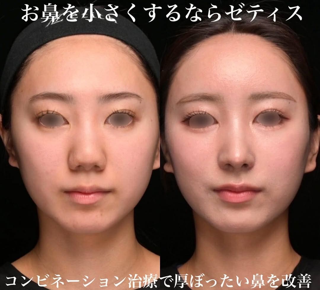 鉄医師による鼻整形の術前/術後３ヶ月