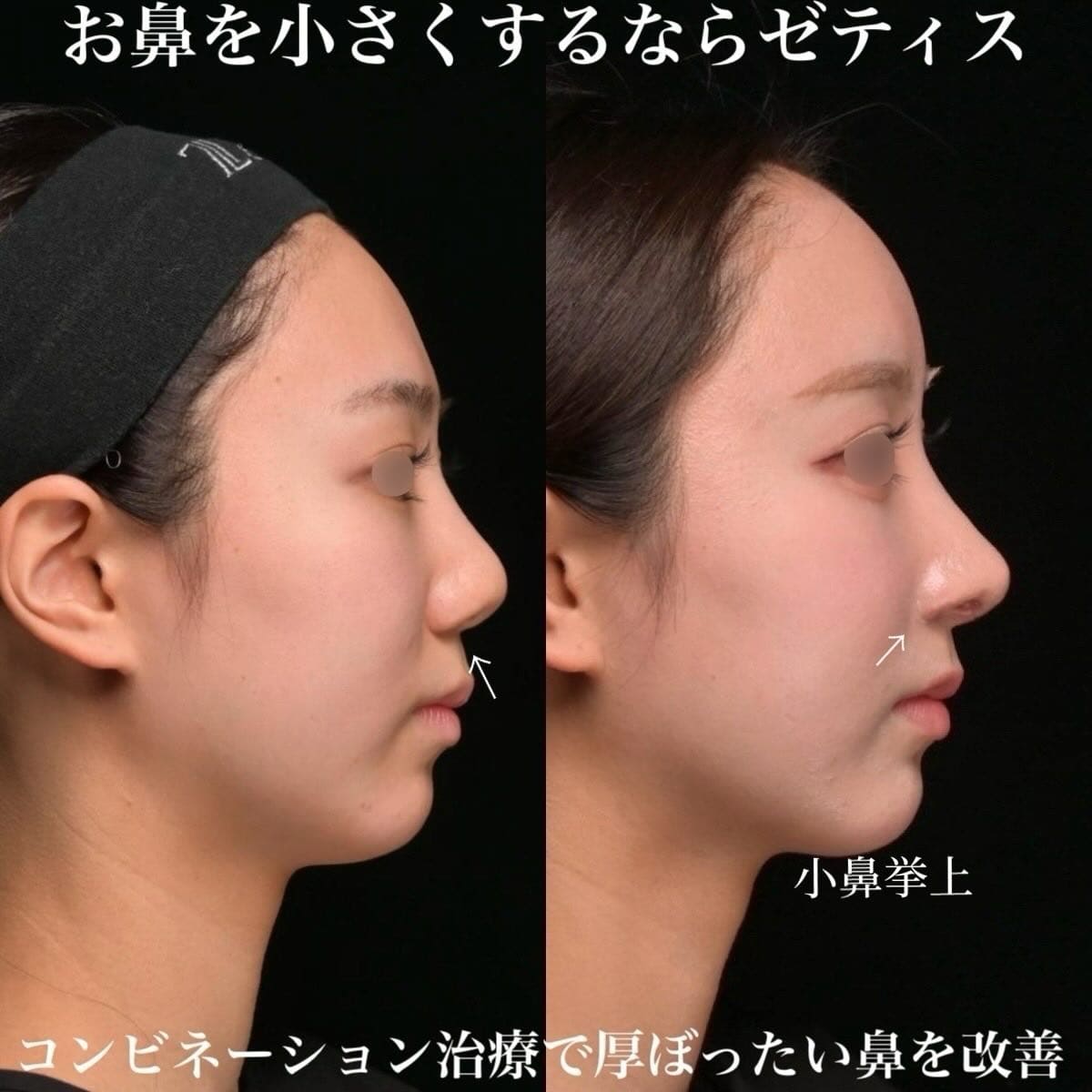 鉄医師による鼻整形の術前/術後３ヶ月 หลัง 