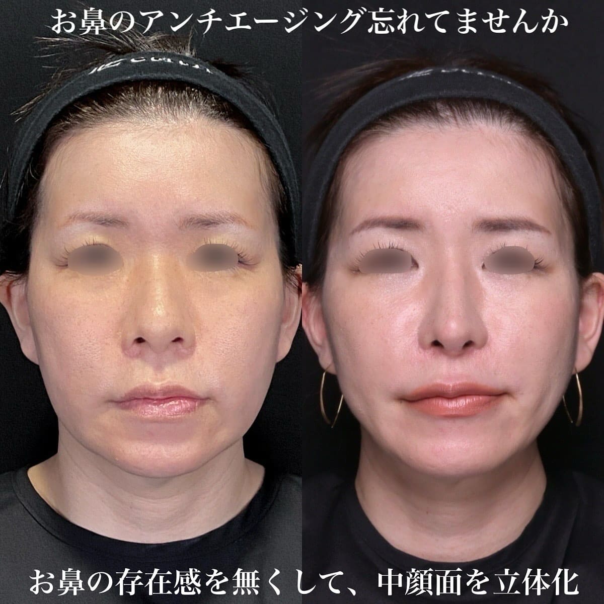 鉄医師による鼻整形の術前/術後6ヶ月