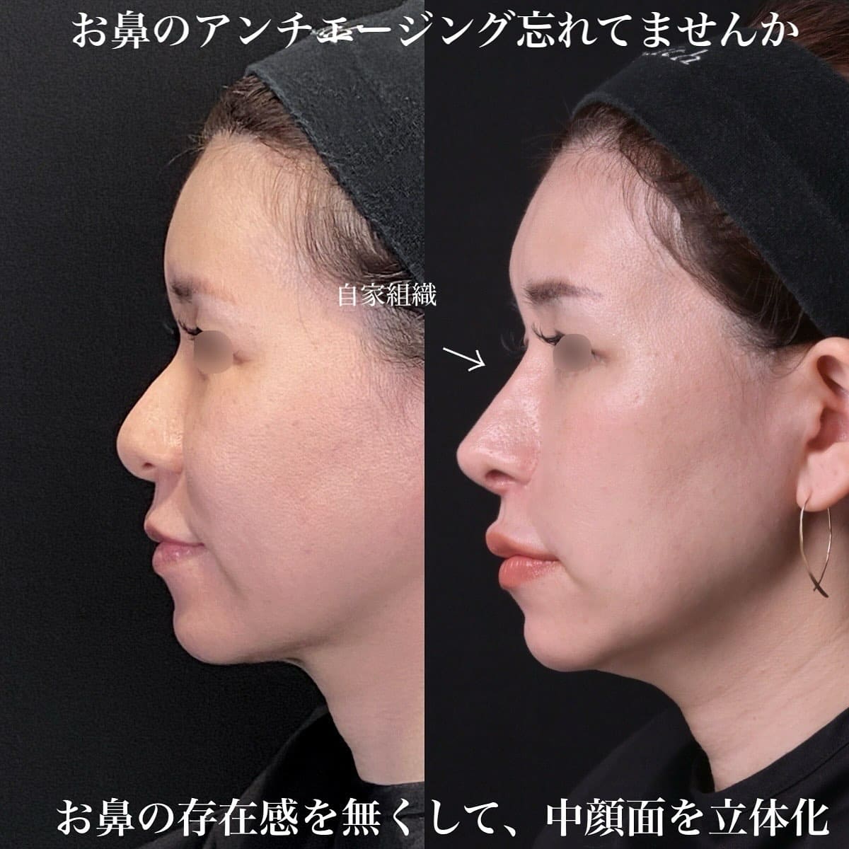 鉄医師による鼻整形の術前/術後6ヶ月 After 