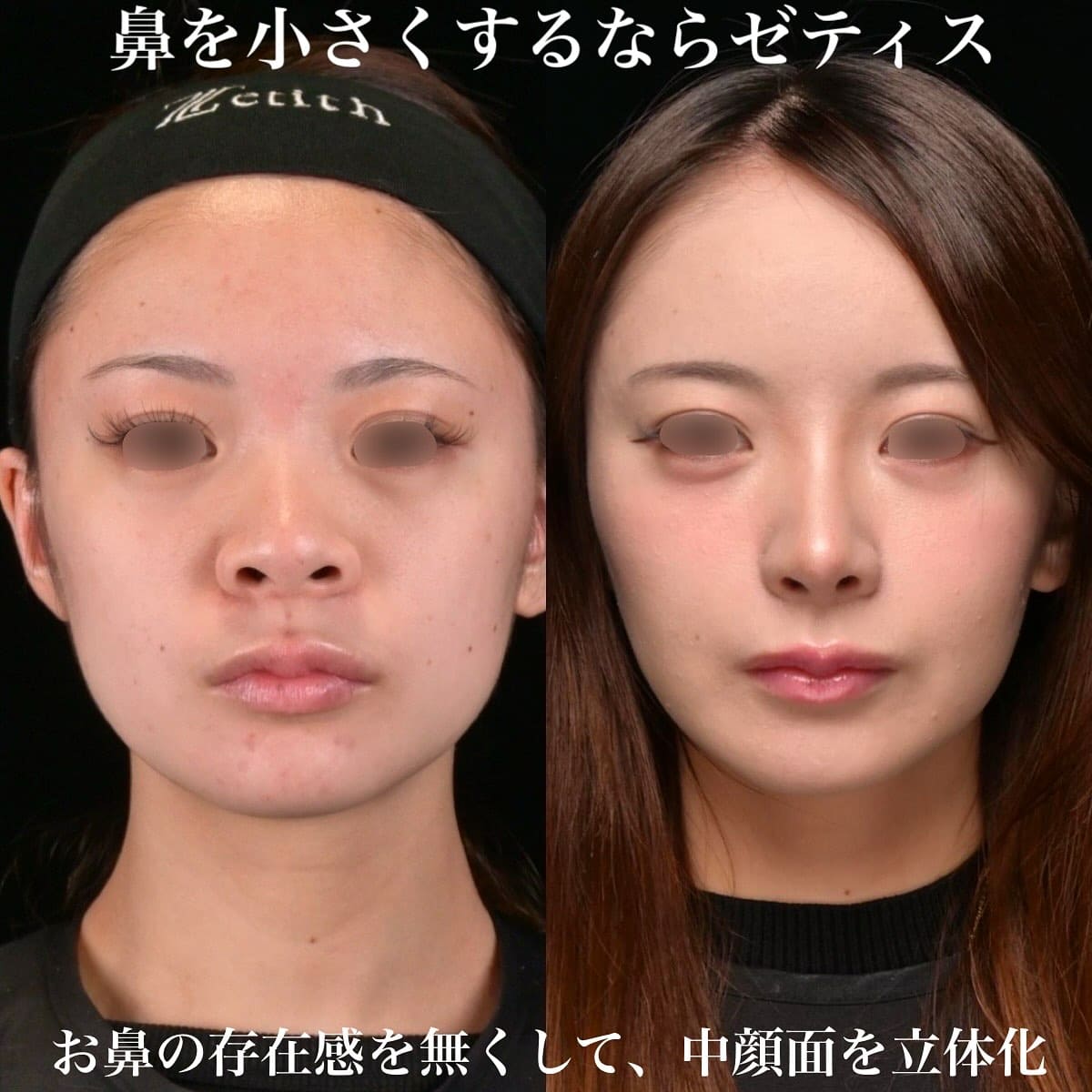 鉄医師による鼻整形の術前/術後ヶ月