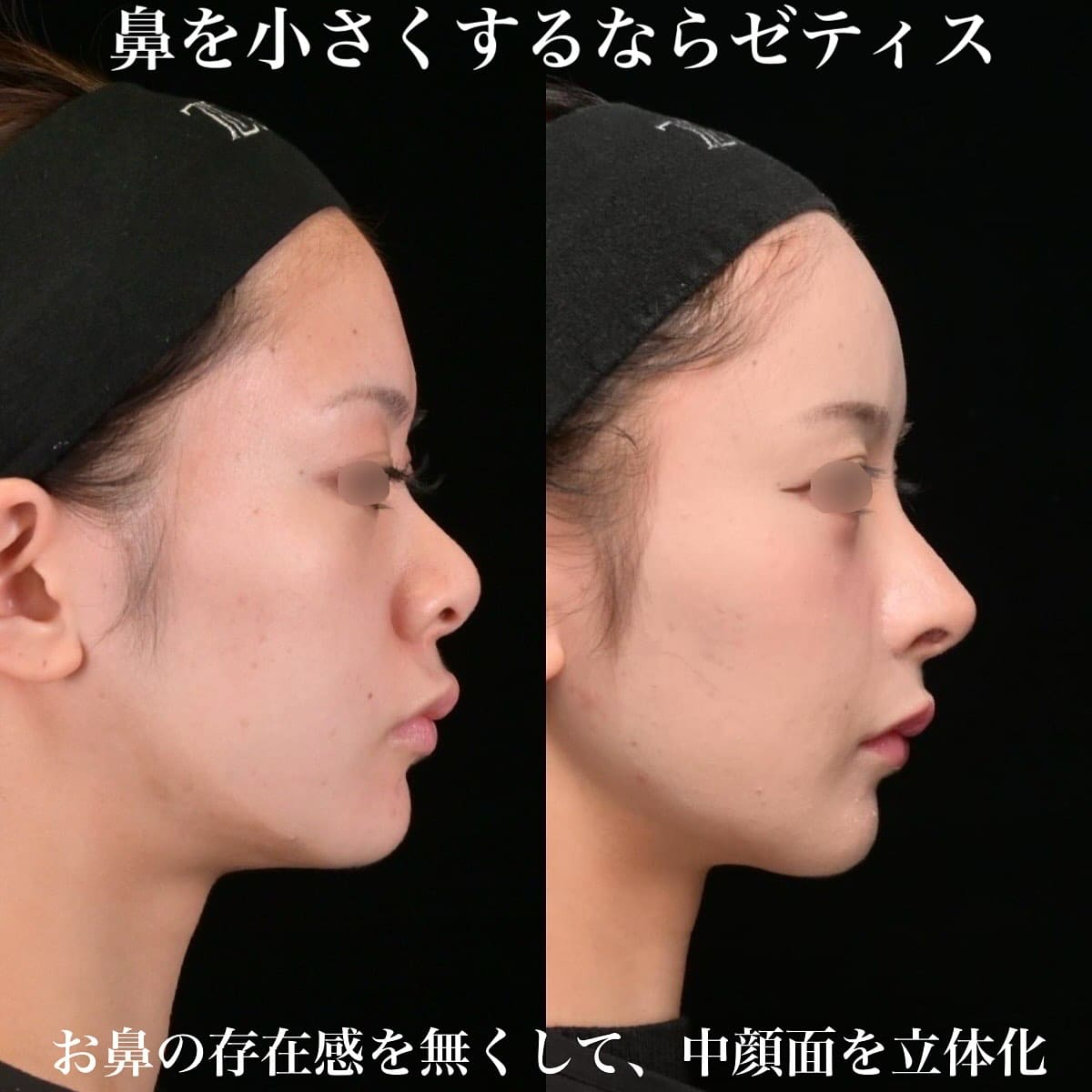 鉄医師による鼻整形の術前/術後ヶ月 بعد 