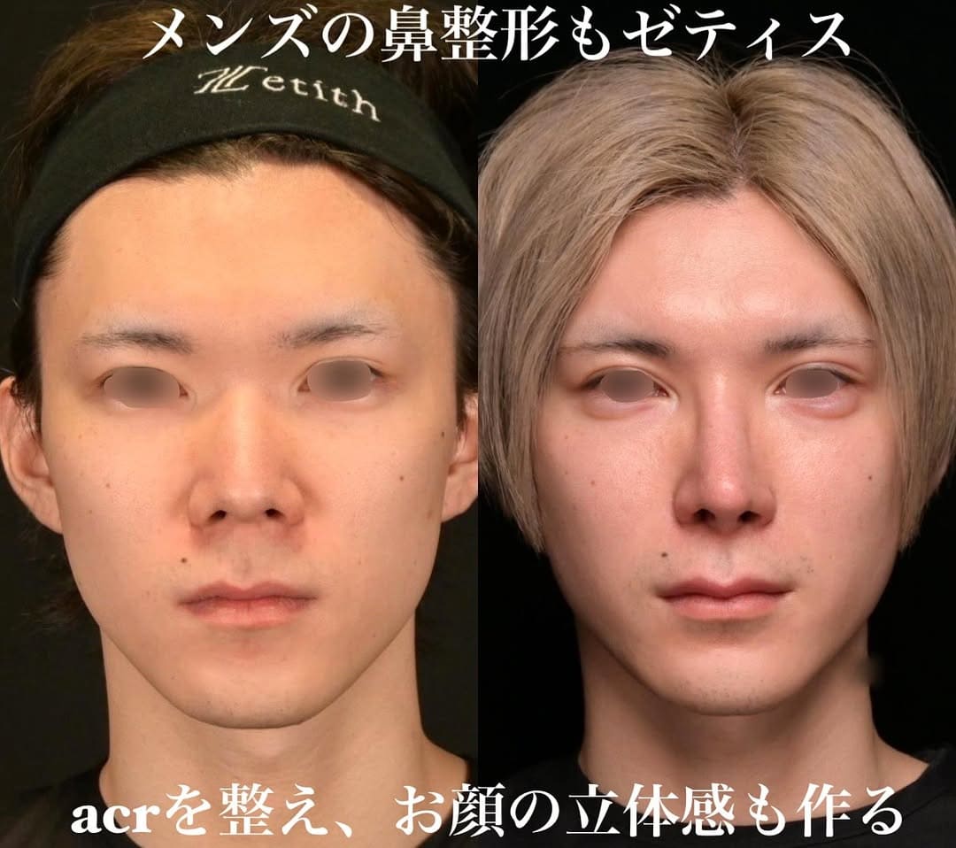 鉄医師による鼻整形の術前/術後1年