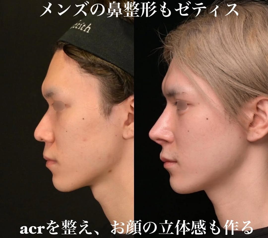 鉄医師による鼻整形の術前/術後1年 术后 