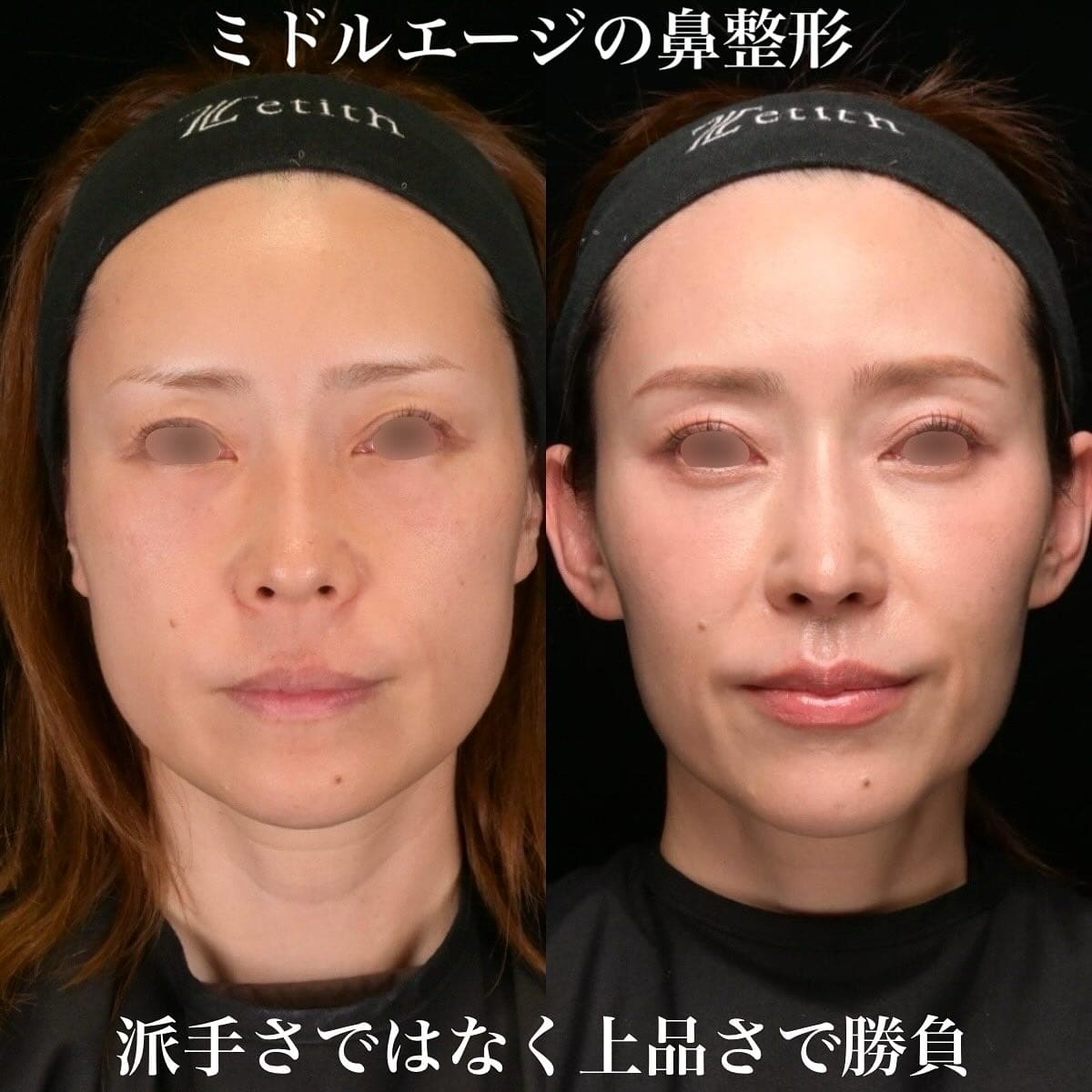 鉄医師による鼻整形の術前/術後6ヶ月
