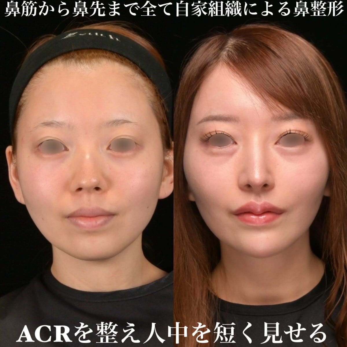 鉄医師による鼻整形の術前/術後6ヶ月