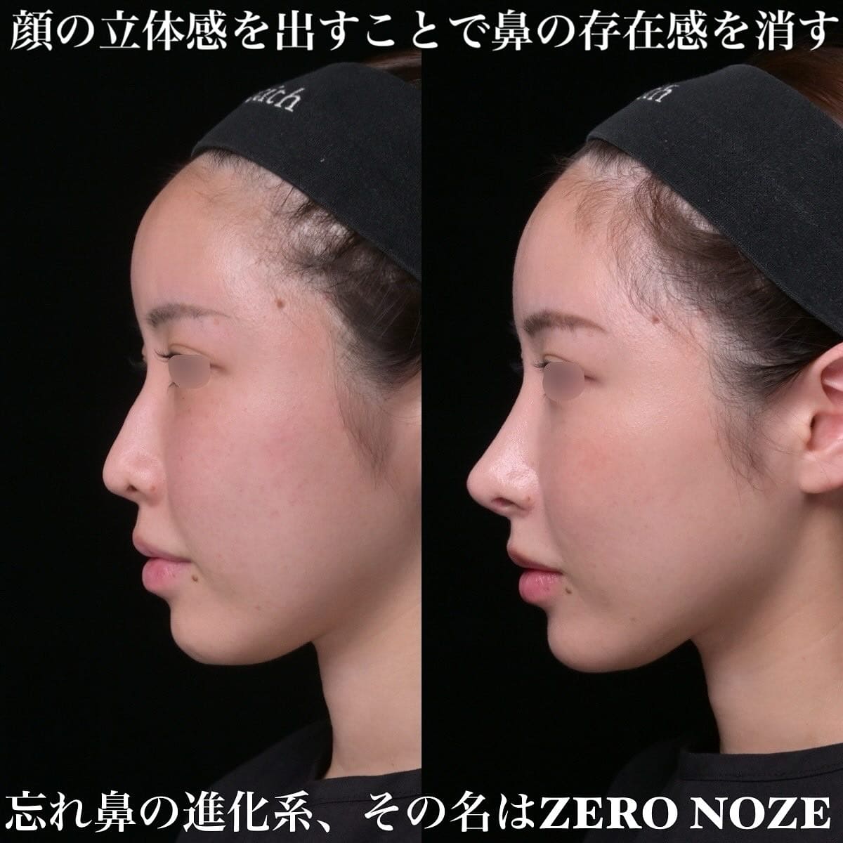 鉄医師による鼻整形の術前/術後３ヶ月 Дараа 
