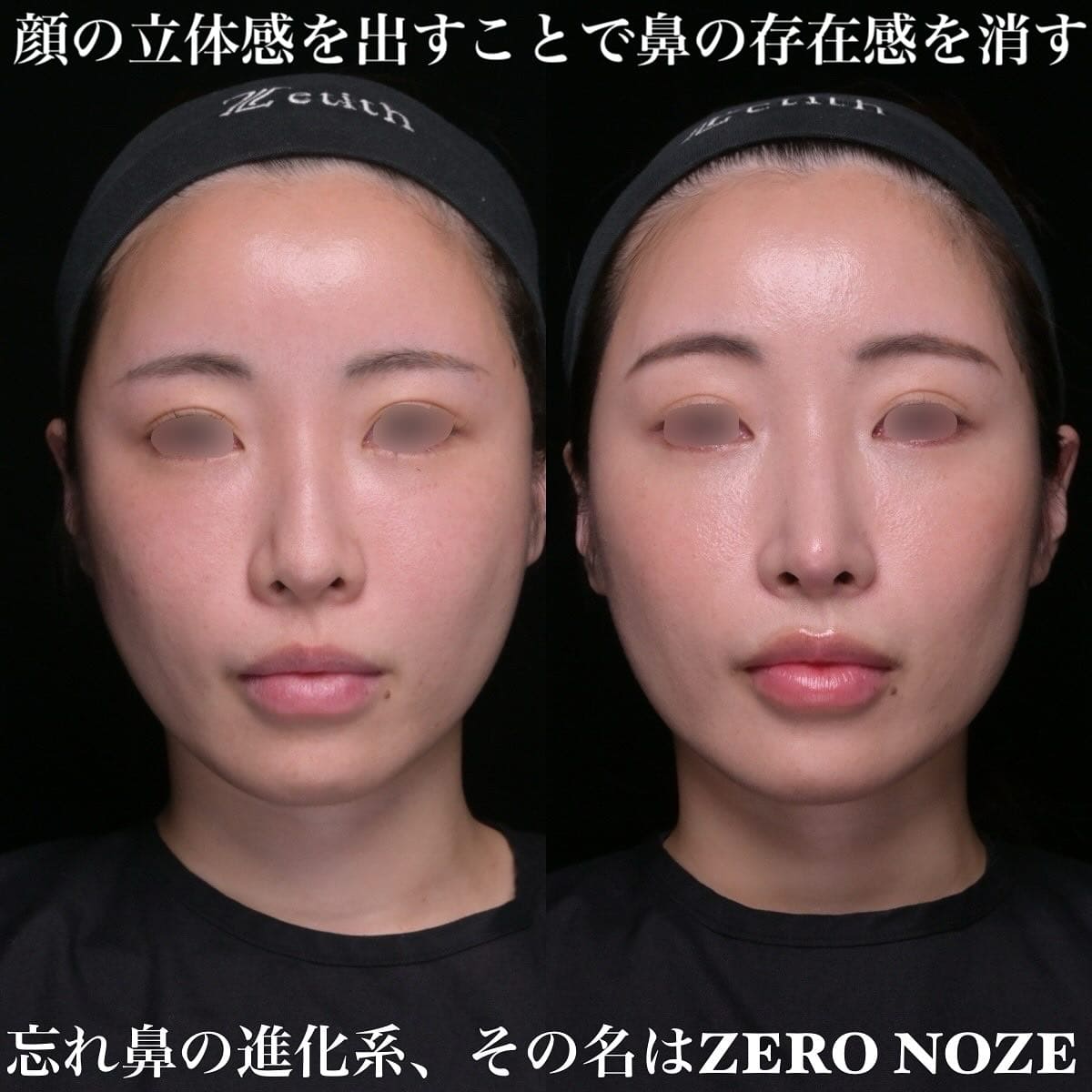 鉄医師による鼻整形の術前/術後３ヶ月
