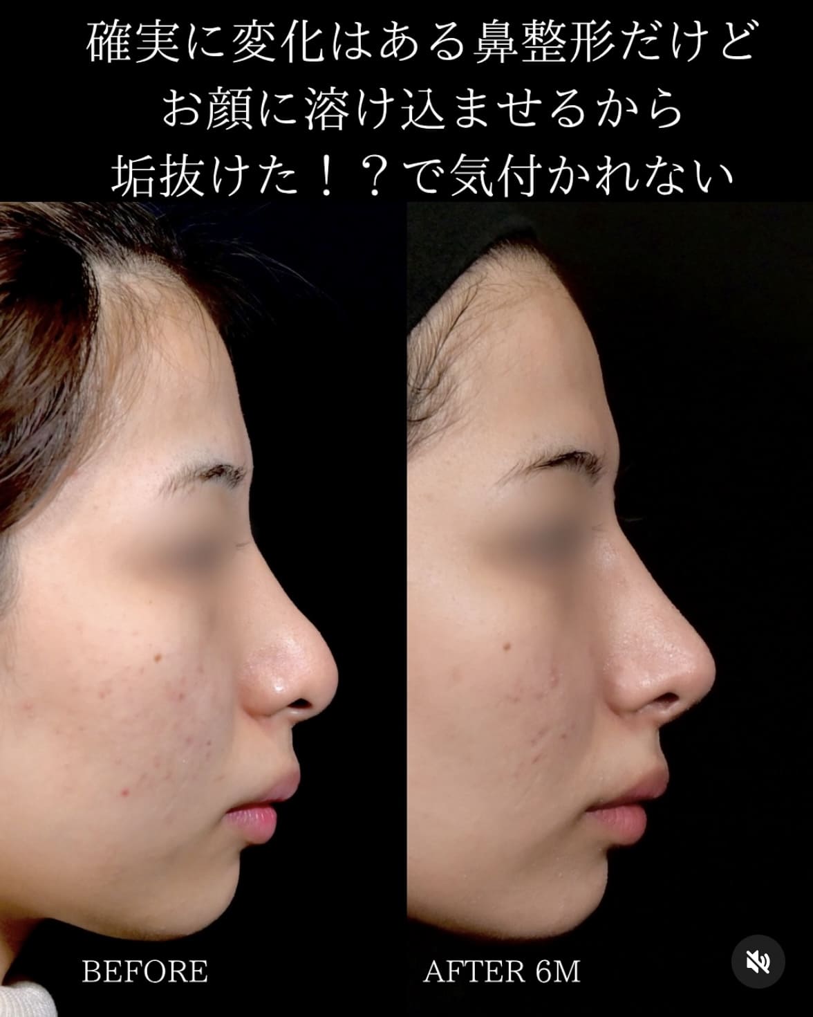 守屋医師による鼻整形の術前/術後