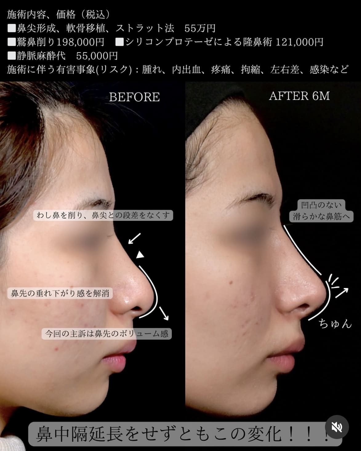 守屋医師による鼻整形の術前/術後 施術後 