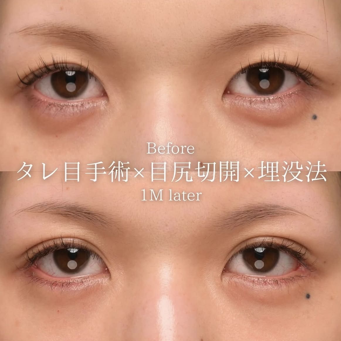 楠本医師による目元の複合施術の術前/術後