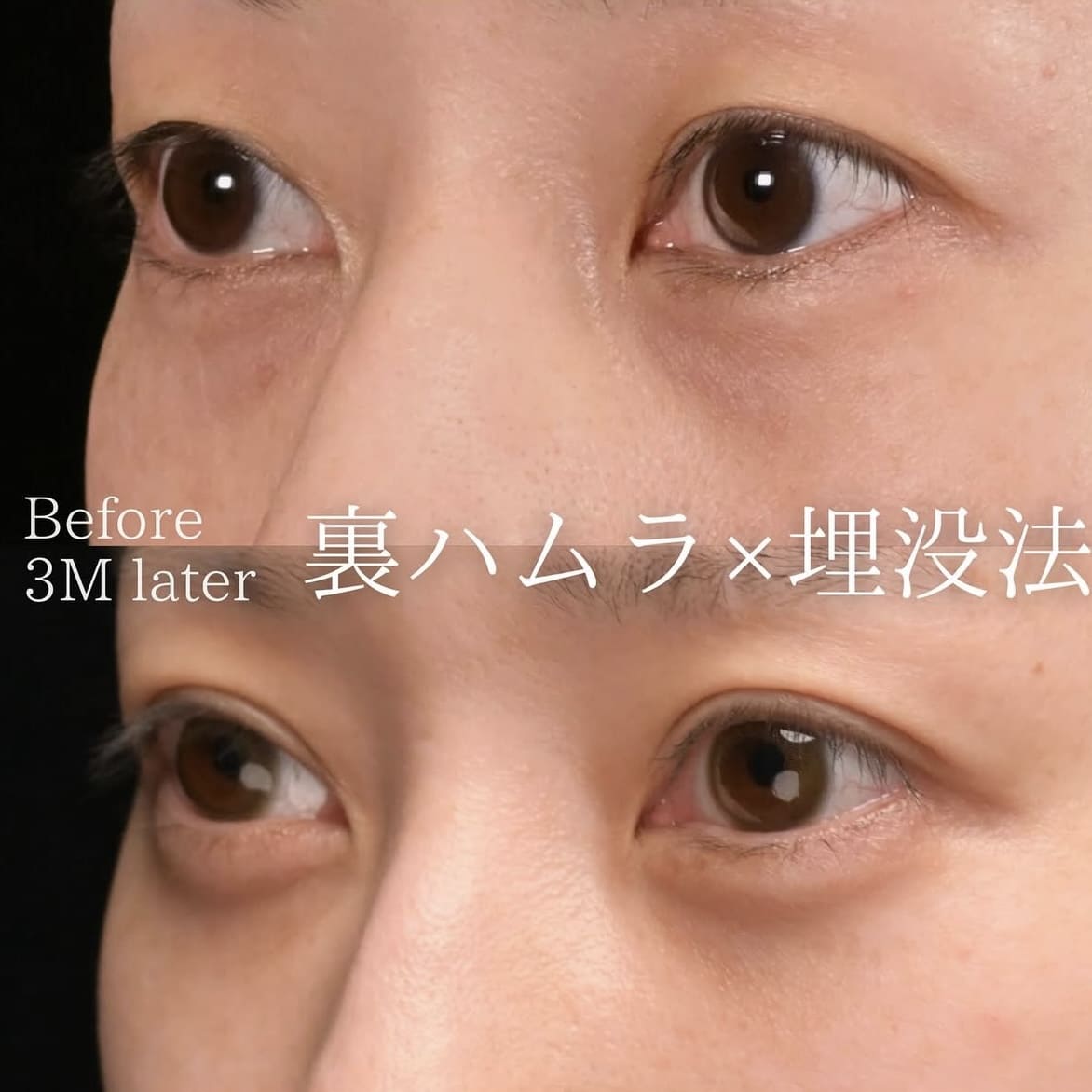 楠本医師による目元の複合施術の術前/術後