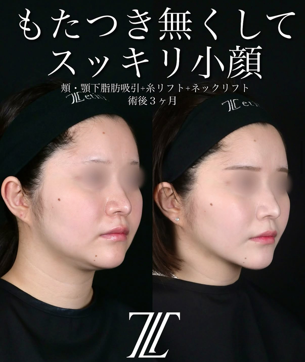 北村医師による脂肪吸引リフトの術前/術後3ヶ月 施術後 