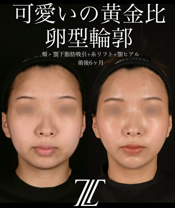 北村医師による脂肪吸引リフトの術前/術後6ヶ月