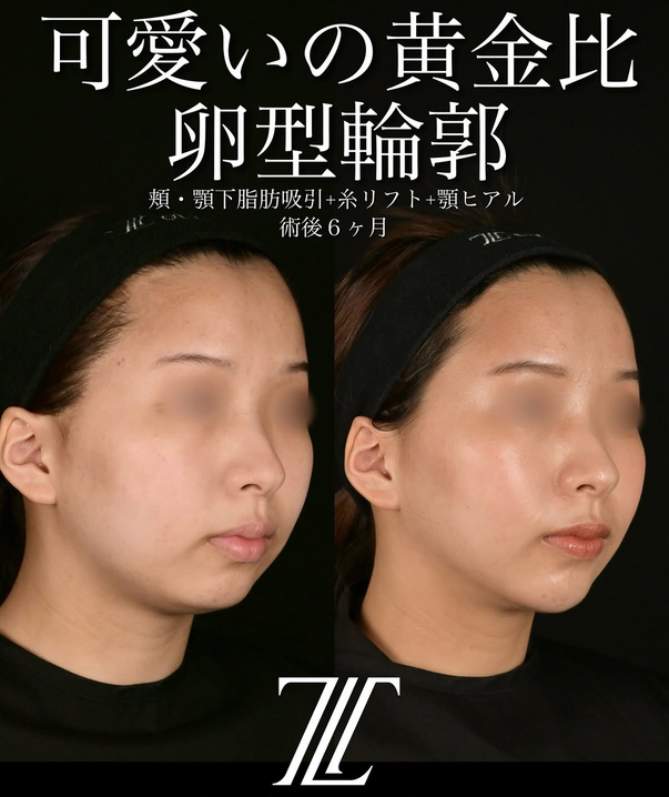 北村医師による脂肪吸引リフトの術前/術後6ヶ月 After 