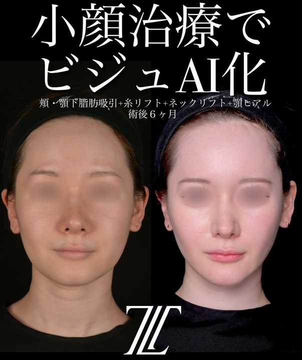 北浦医師による脂肪吸引リフトの術前/術後6ヶ月