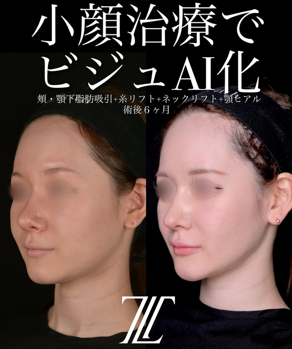北浦医師による脂肪吸引リフトの術前/術後6ヶ月 施術後 