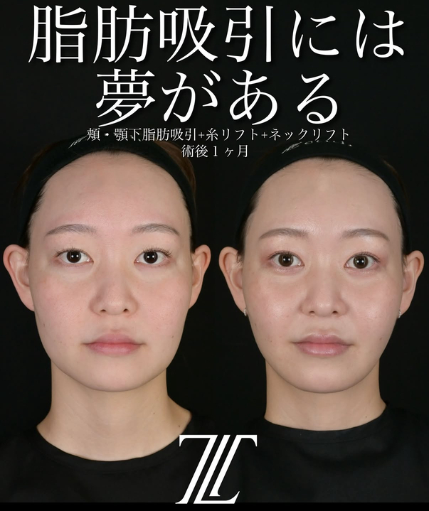 北村医師による脂肪吸引リフトの術前/術後1ヶ月