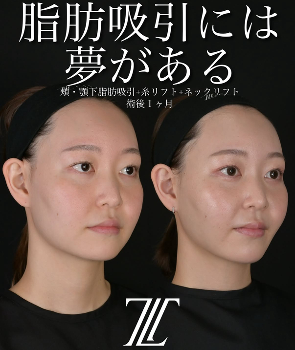 北村医師による脂肪吸引リフトの術前/術後1ヶ月 施術後 