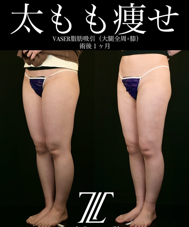 北村医師による脂肪吸引の術前/術後1ヶ月 | 症例写真 — ゼティス