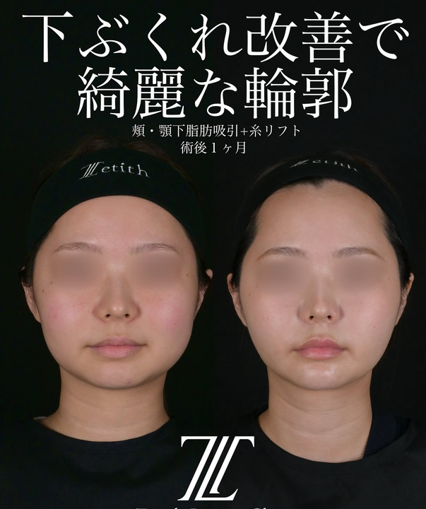 北村医師による脂肪吸引リフトの術前/術後1ヶ月
