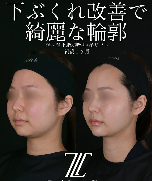 北村医師による脂肪吸引リフトの術前/術後1ヶ月 施術後 