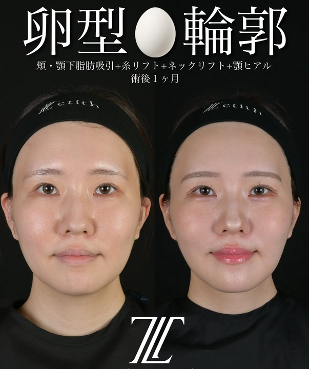 北村医師による脂肪吸引リフトの術前/術後1ヶ月