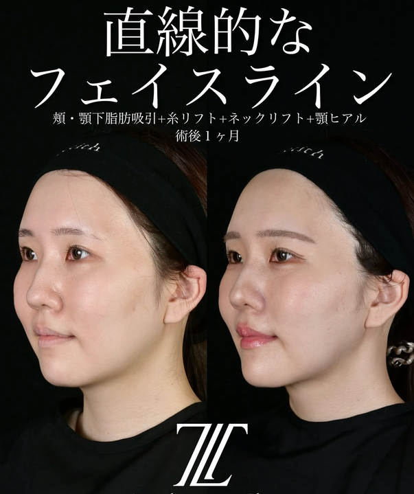 北村医師による脂肪吸引リフトの術前/術後1ヶ月 หลัง 