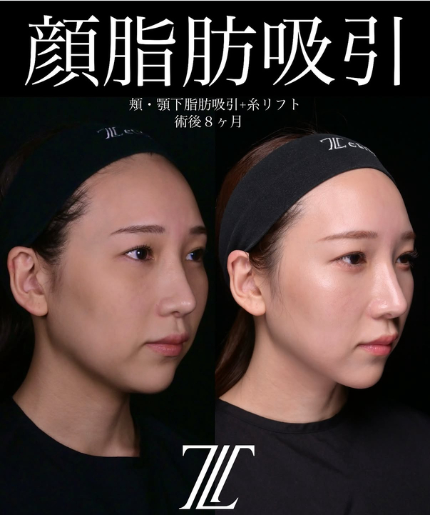 北村医師による脂肪吸引リフトの術前/術後8ヶ月 بعد 