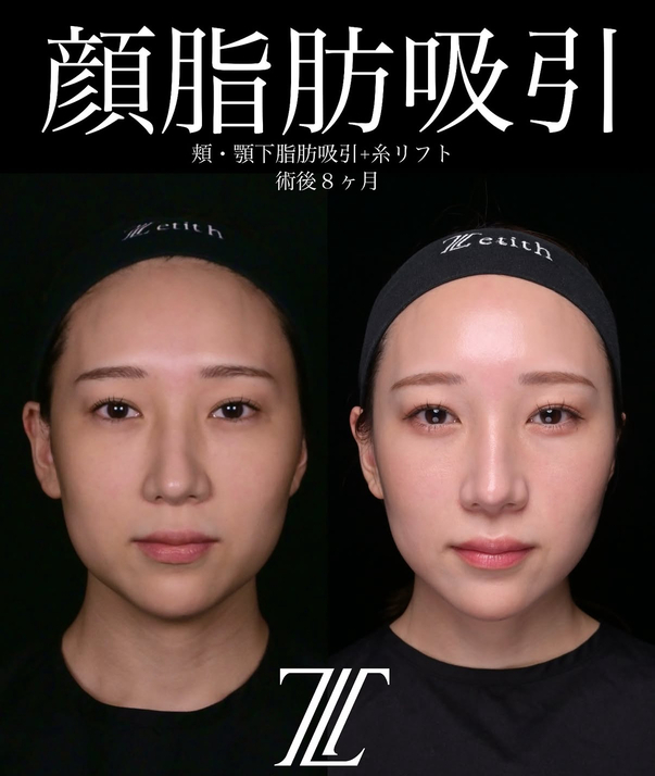 北村医師による脂肪吸引リフトの術前/術後8ヶ月