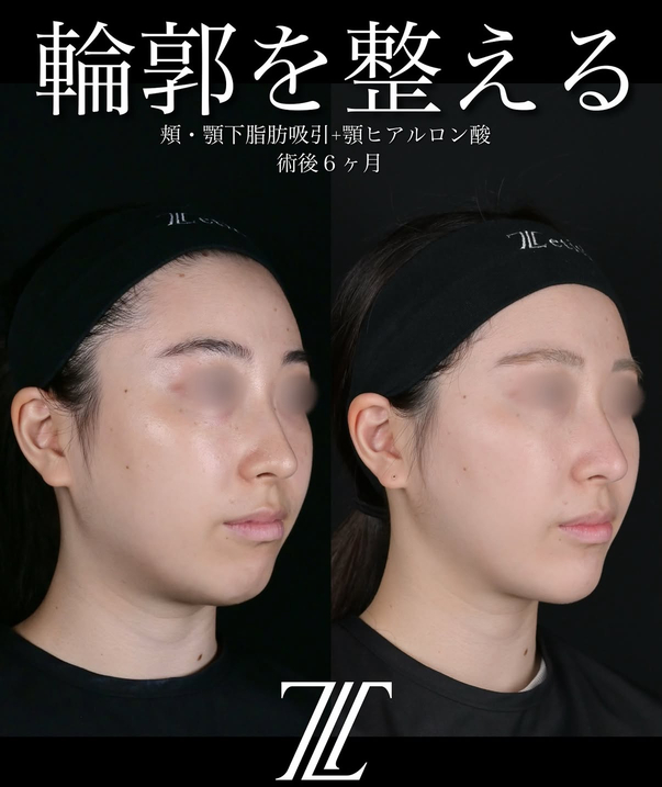 北村医師による脂肪吸引リフトの術前/術後6ヶ月 After 