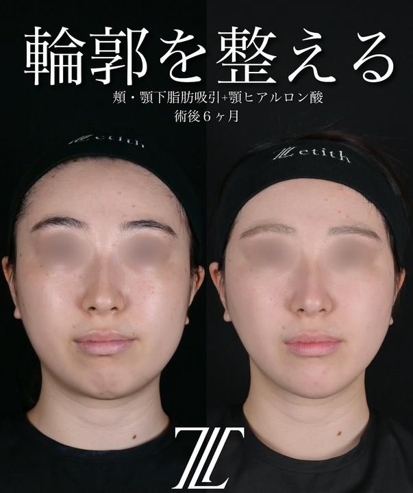 北村医師による脂肪吸引リフトの術前/術後6ヶ月