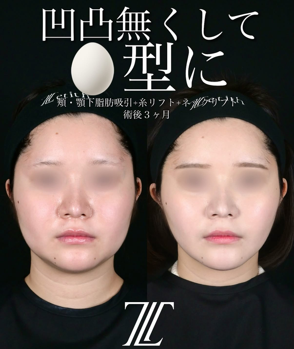 北村医師による脂肪吸引リフトの術前/術後3ヶ月