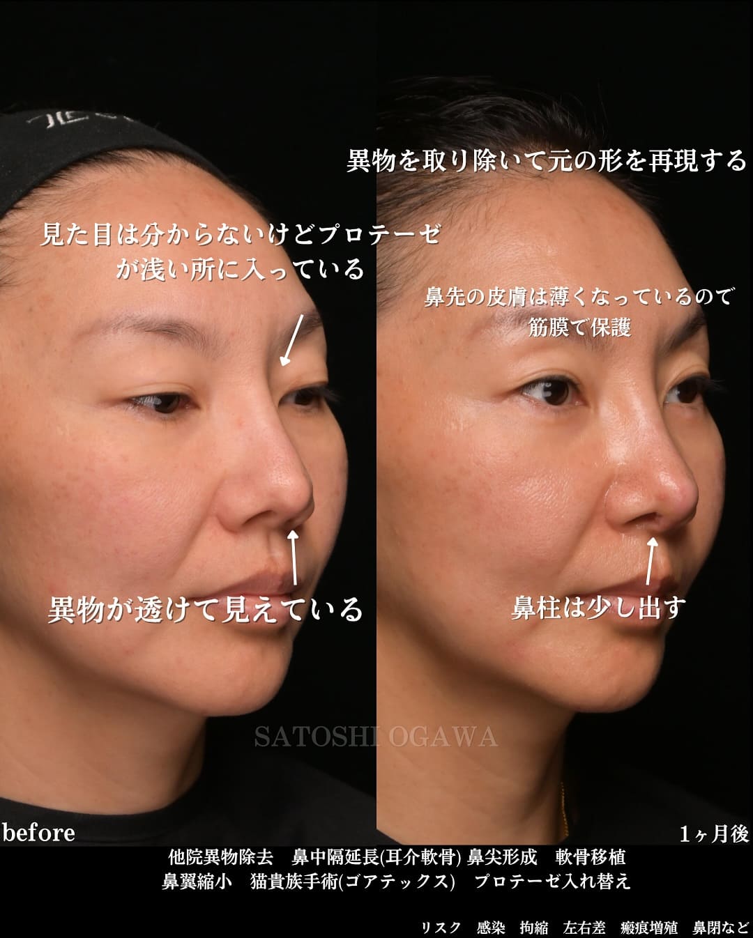 小川医師による鼻整形の術前/術後1ヶ月 施術後 