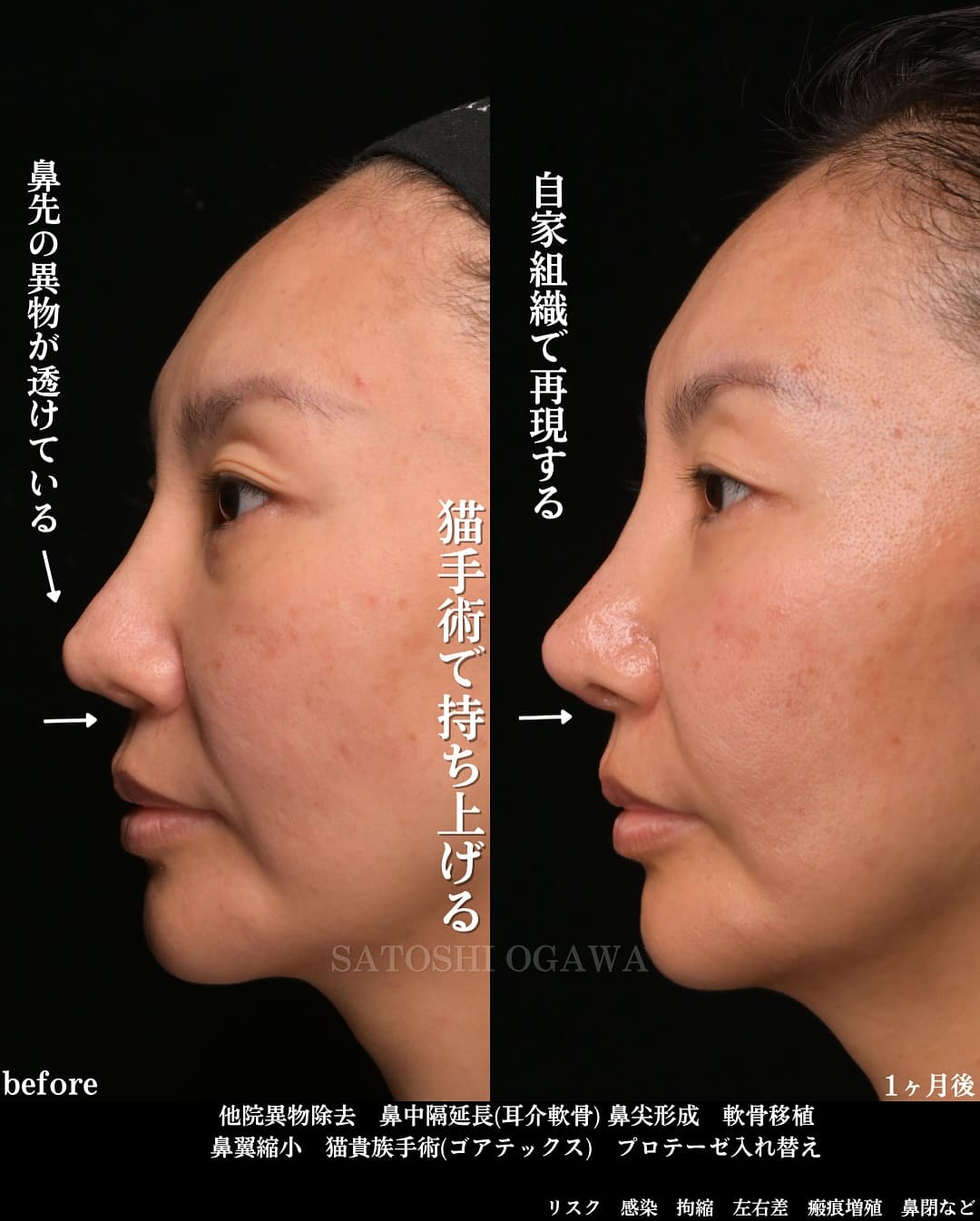 小川医師による鼻整形の術前/術後1ヶ月