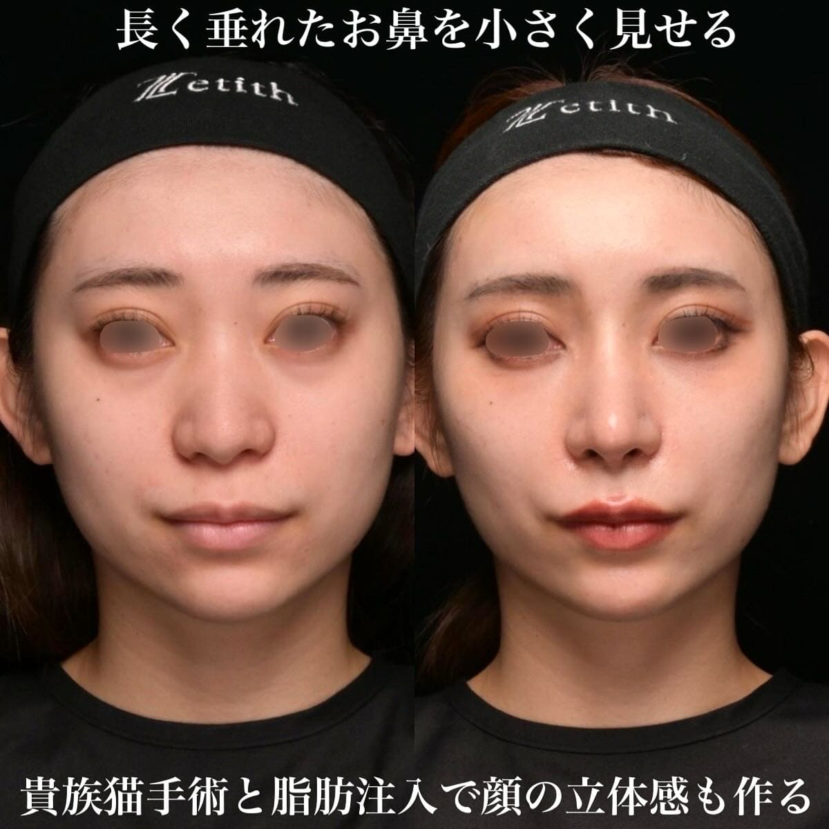 鉄医師による鼻整形の術前/術後３ヶ月