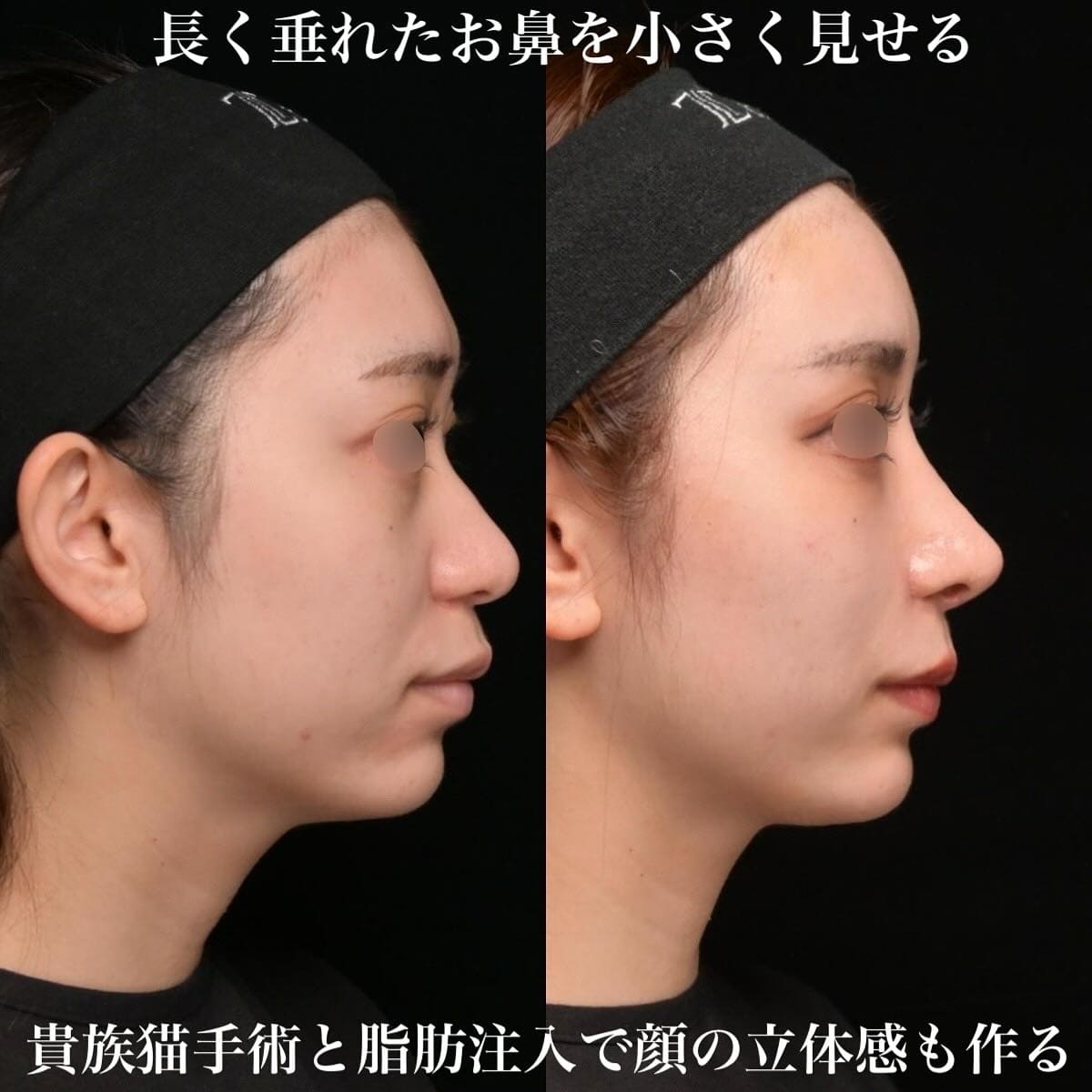 鉄医師による鼻整形の術前/術後３ヶ月 施術後 