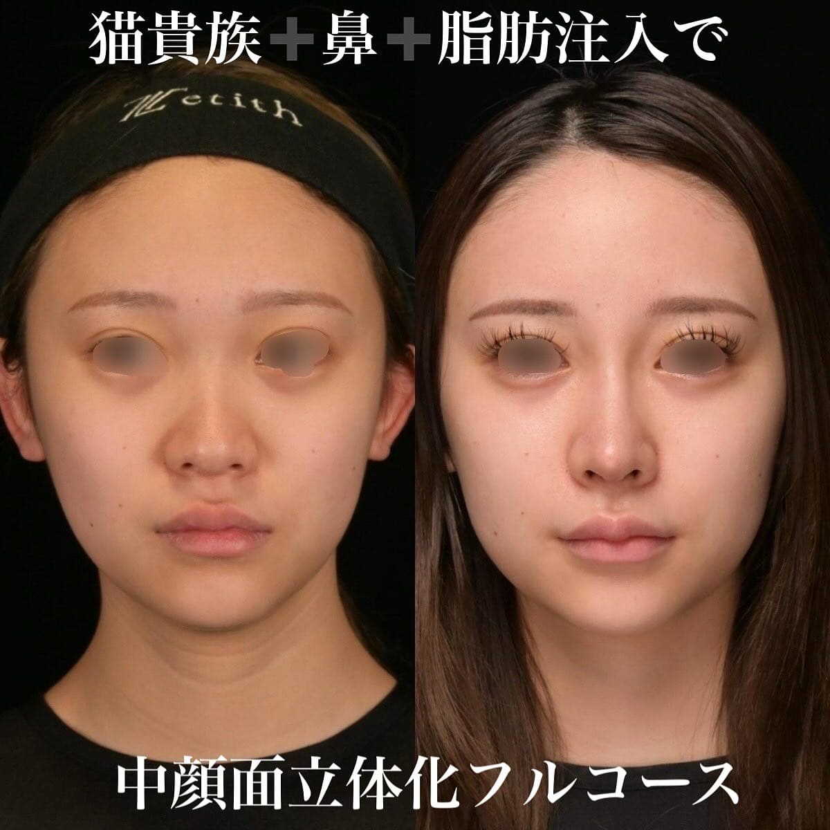 鉄医師による鼻整形の術前/術後6ヶ月