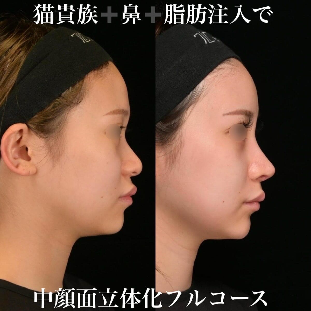 鉄医師による鼻整形の術前/術後6ヶ月 หลัง 