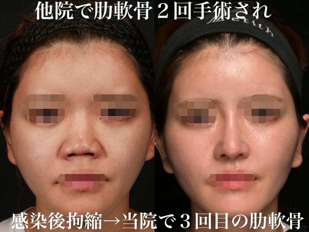 鉄医師による鼻整形の術前/術後1ヶ月