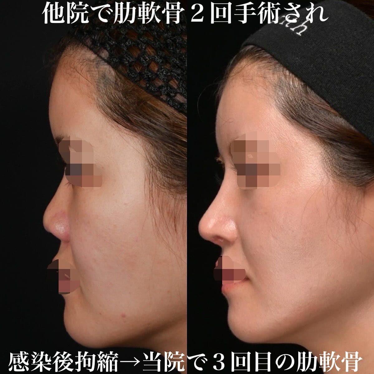 鉄医師による鼻整形の術前/術後1ヶ月 术后 