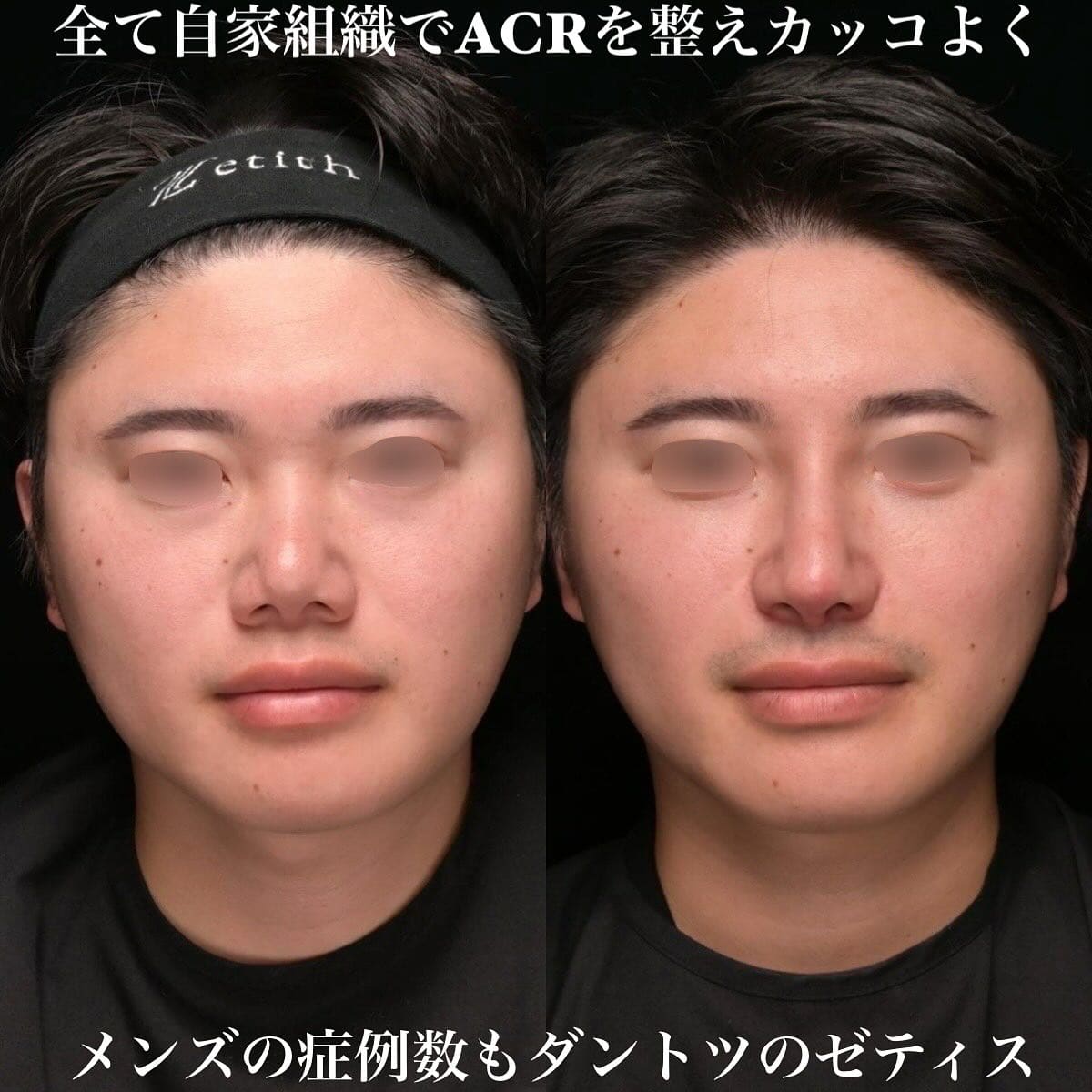 鉄医師による鼻整形の術前/術後1ヶ月