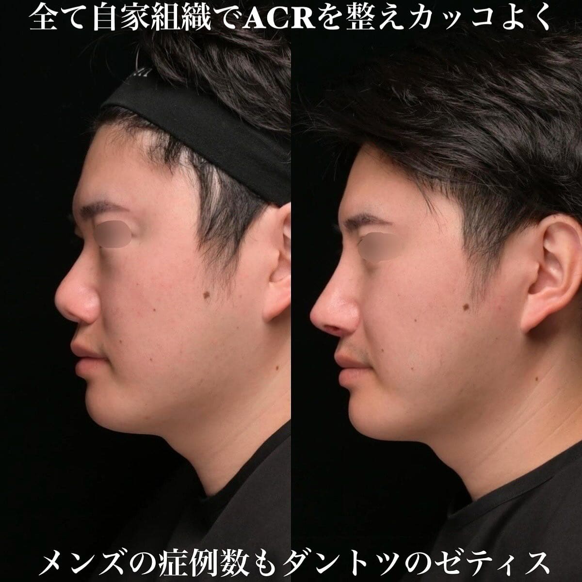 鉄医師による鼻整形の術前/術後1ヶ月 Sonra 