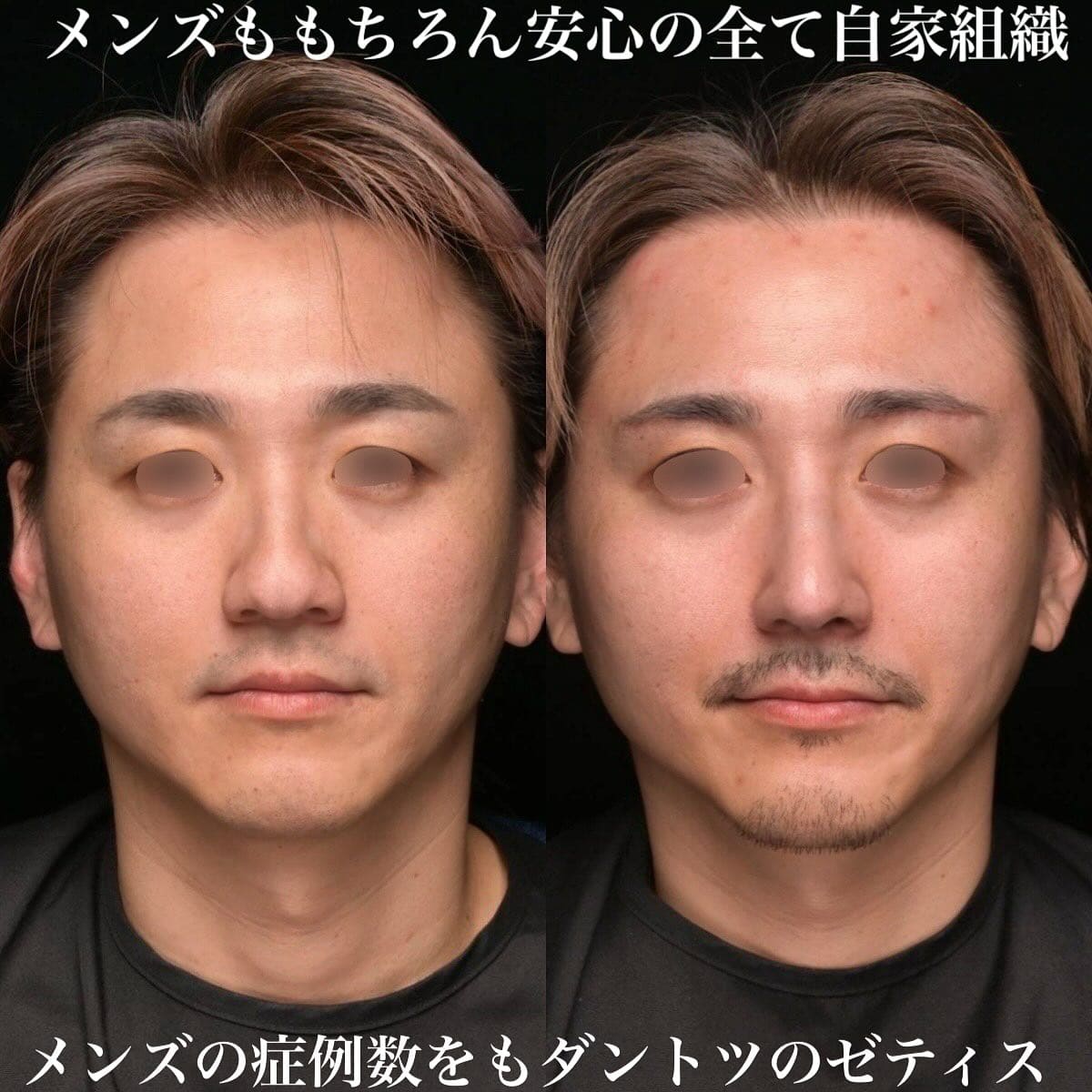 鉄医師による鼻整形の術前/術後1ヶ月