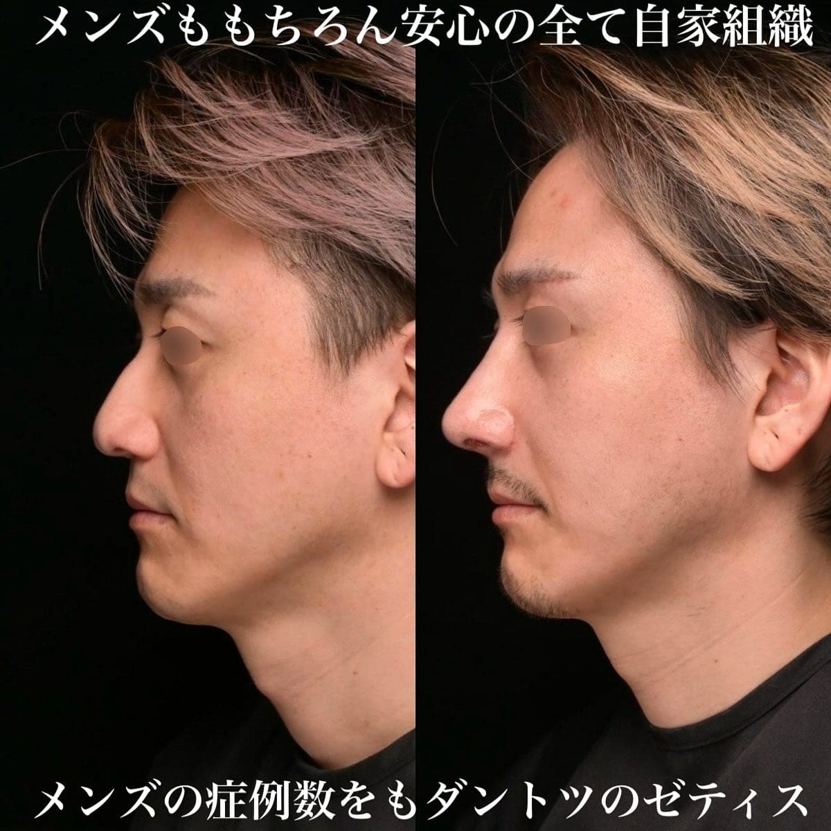 鉄医師による鼻整形の術前/術後1ヶ月 หลัง 