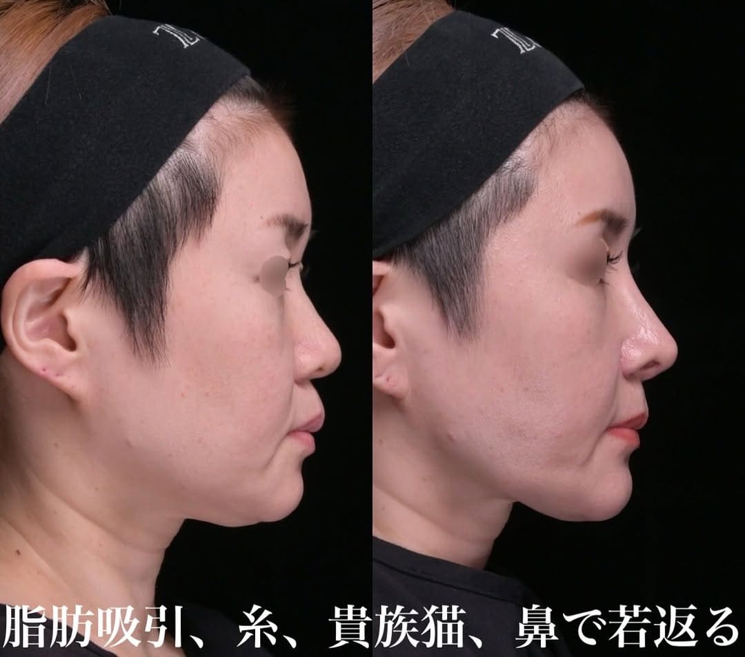 鉄医師による鼻整形の術前/術後３ヶ月 施術後 