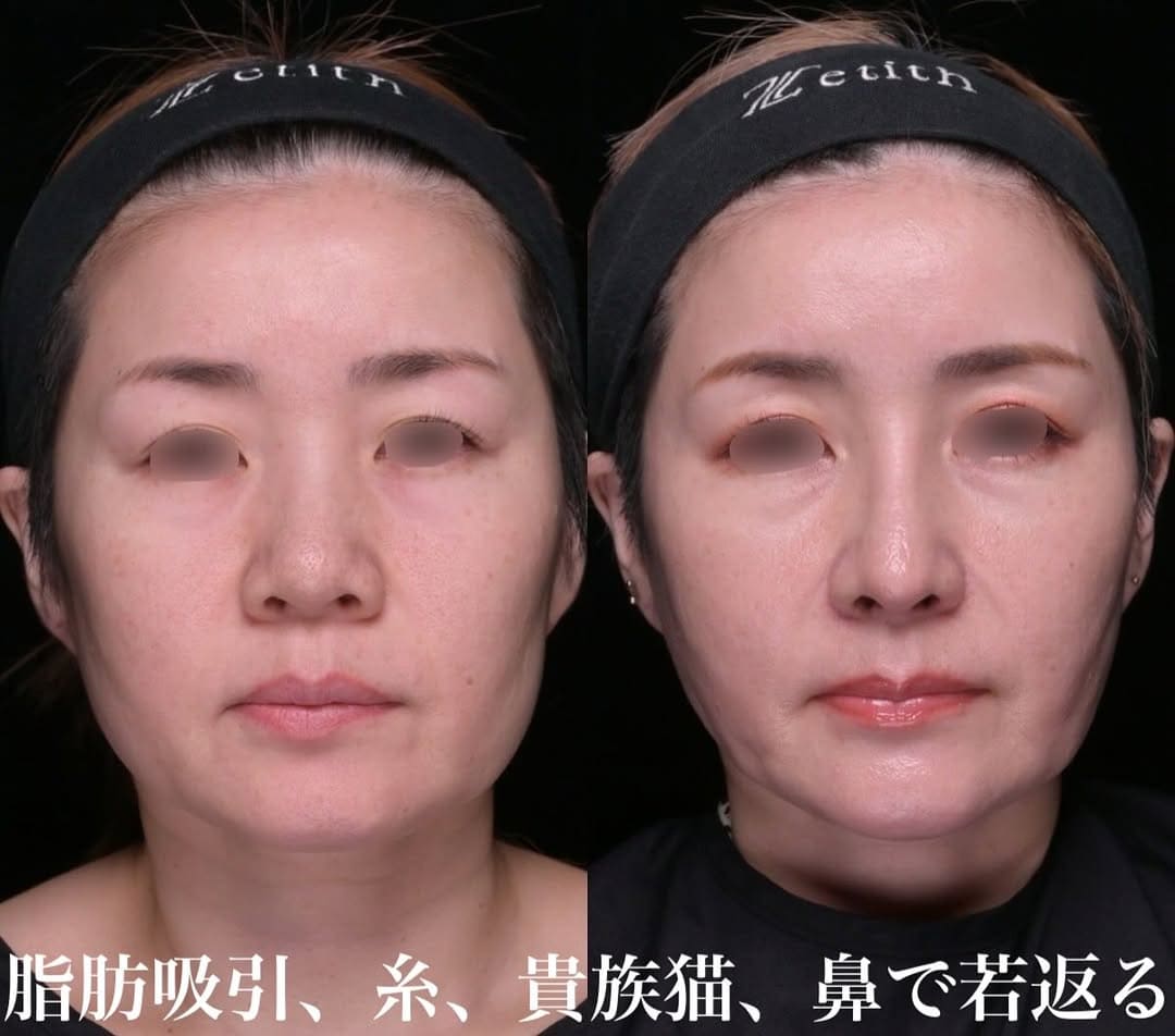 鉄医師による鼻整形の術前/術後３ヶ月